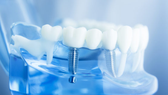 mini-implante-dentario-promete-ser-mais-eficiente-e-acessivel